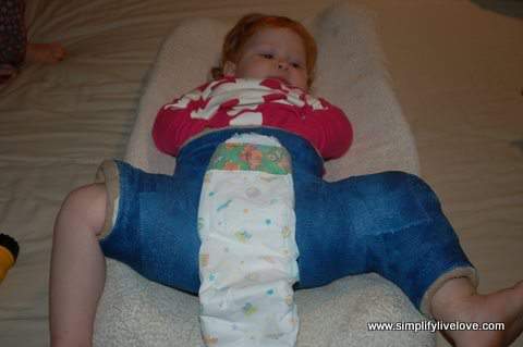 diapering with a hip spica cast